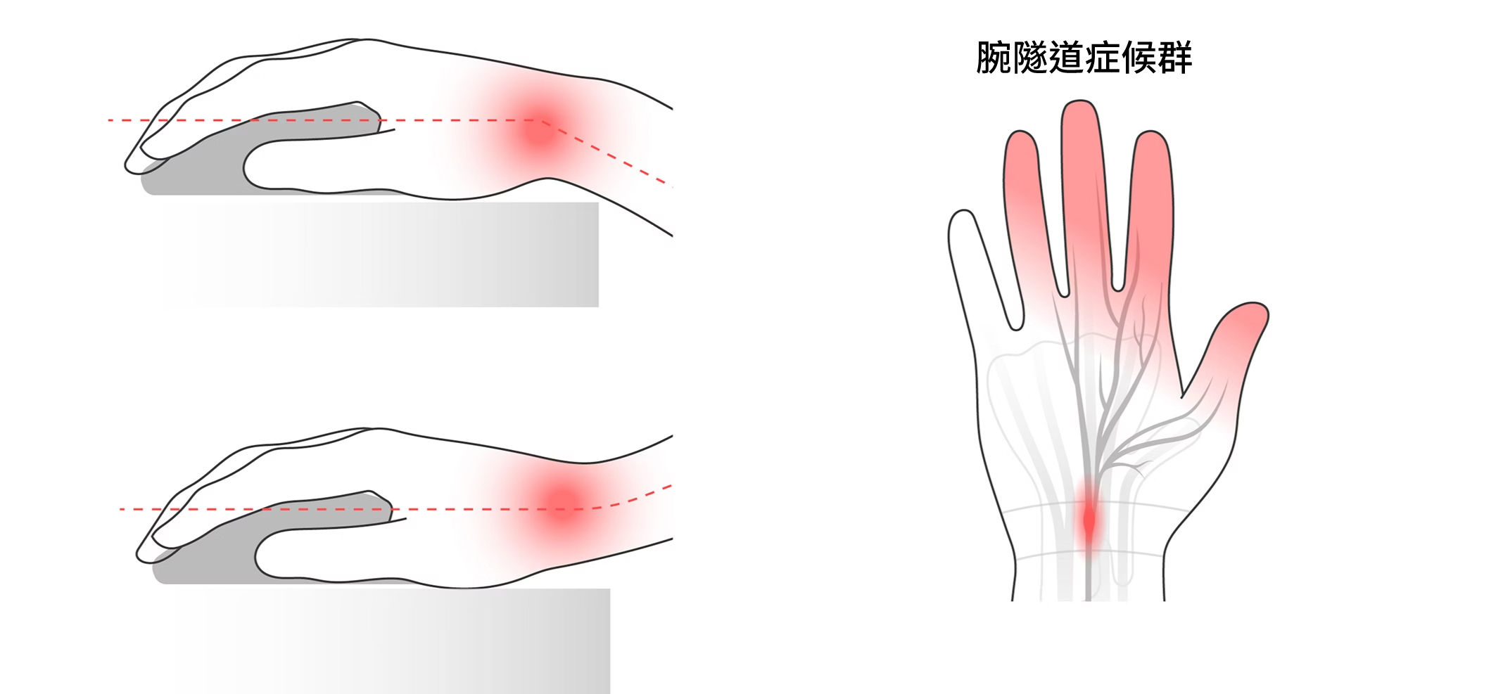插圖示意滑鼠過高或過低造成手腕伸直或屈曲，並突出顯示腕隧道區域。
