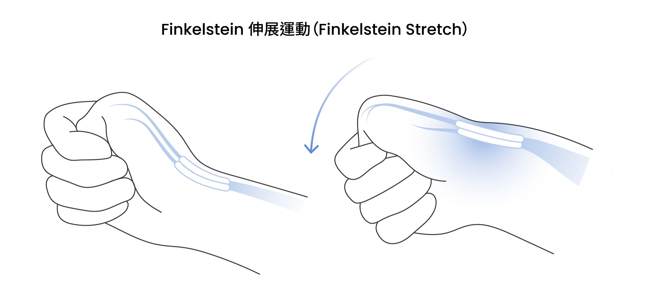 插圖顯示 Finkelstein 伸展操，拇指收進手掌，手腕向小指側彎曲。