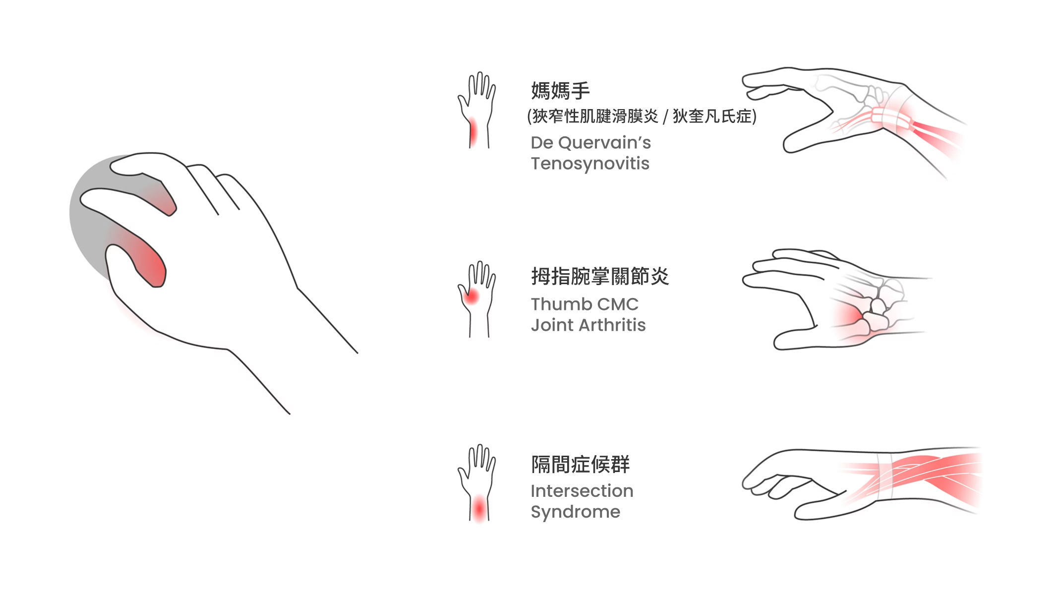 插圖展示過度用力按壓滑鼠，導致拇指、手掌與前臂緊繃。
