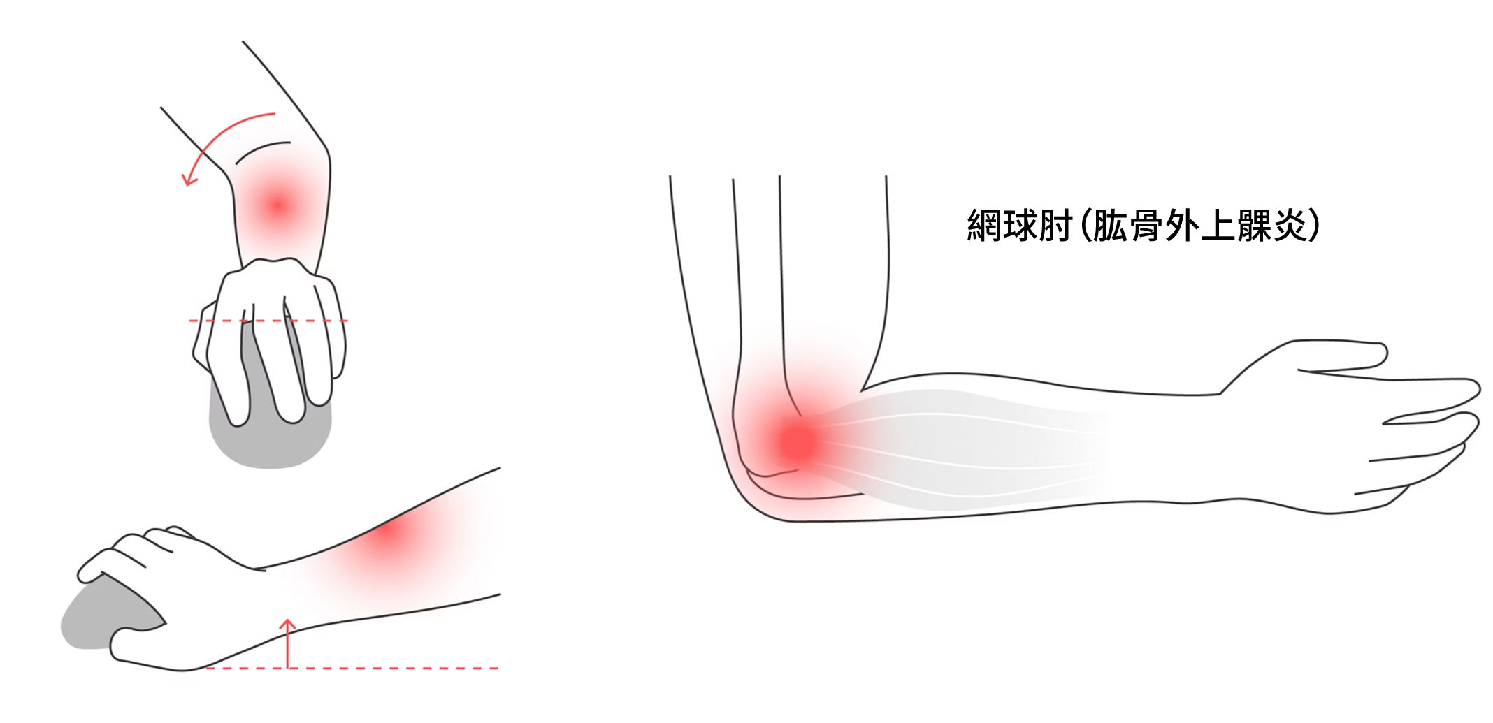插圖呈現使用滑鼠時前臂旋轉的動作，並標示出手腕、前臂與手肘外側承受的壓力。