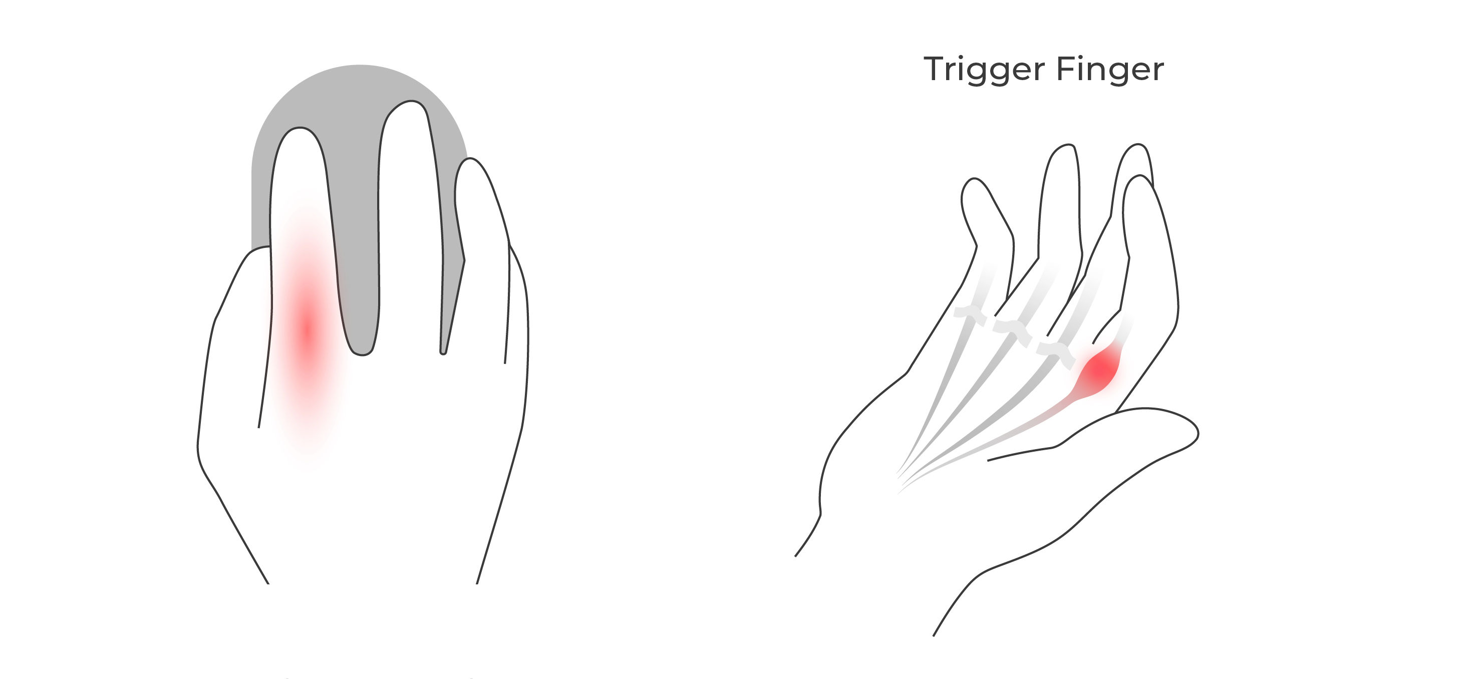 Illustration showing how repetitive mouse clicking and scrolling can strain finger flexor tendons and contribute to trigger finger.