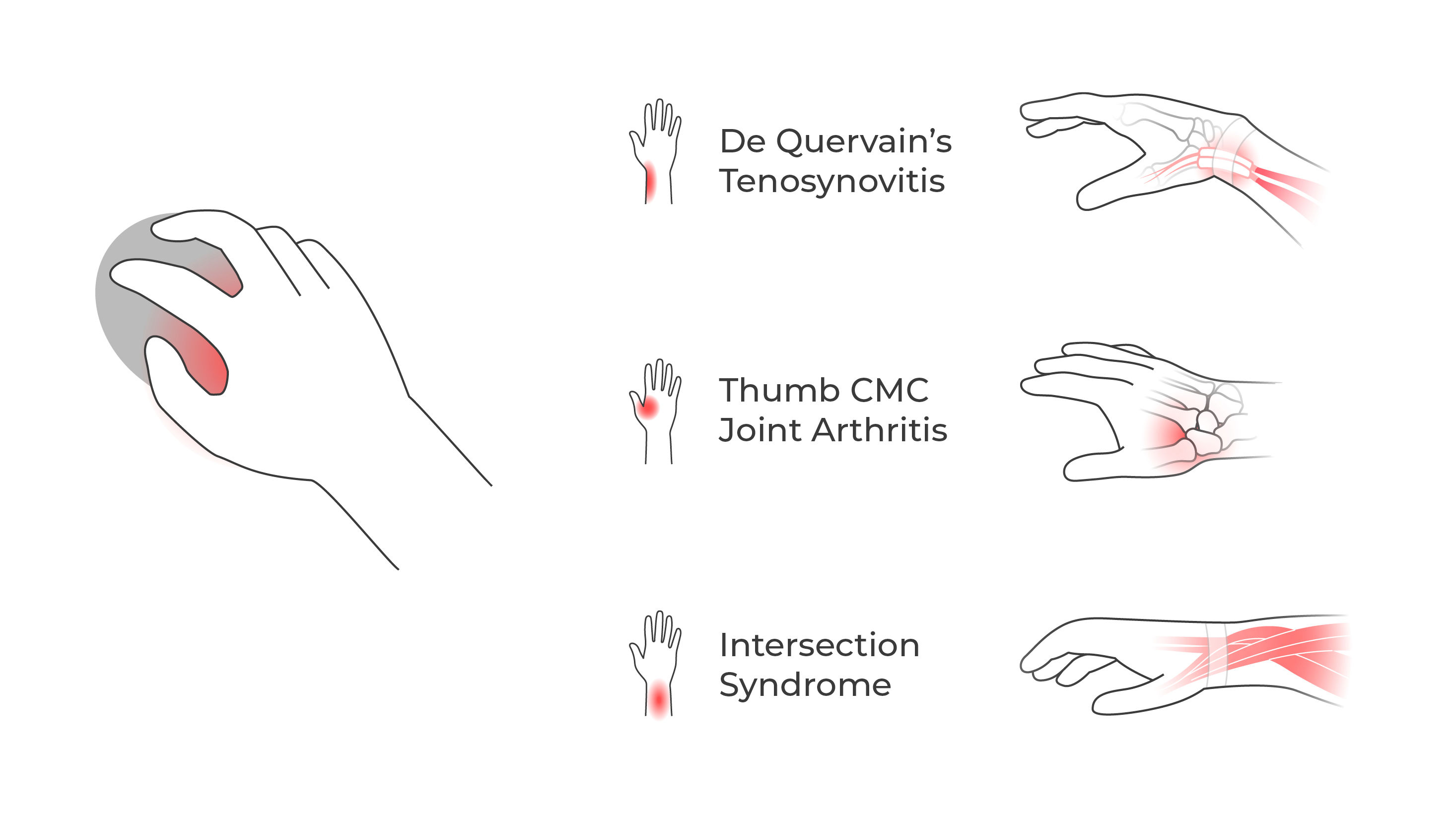 Illustration showing how gripping a mouse too tightly can strain the thumb, hand, and forearm.