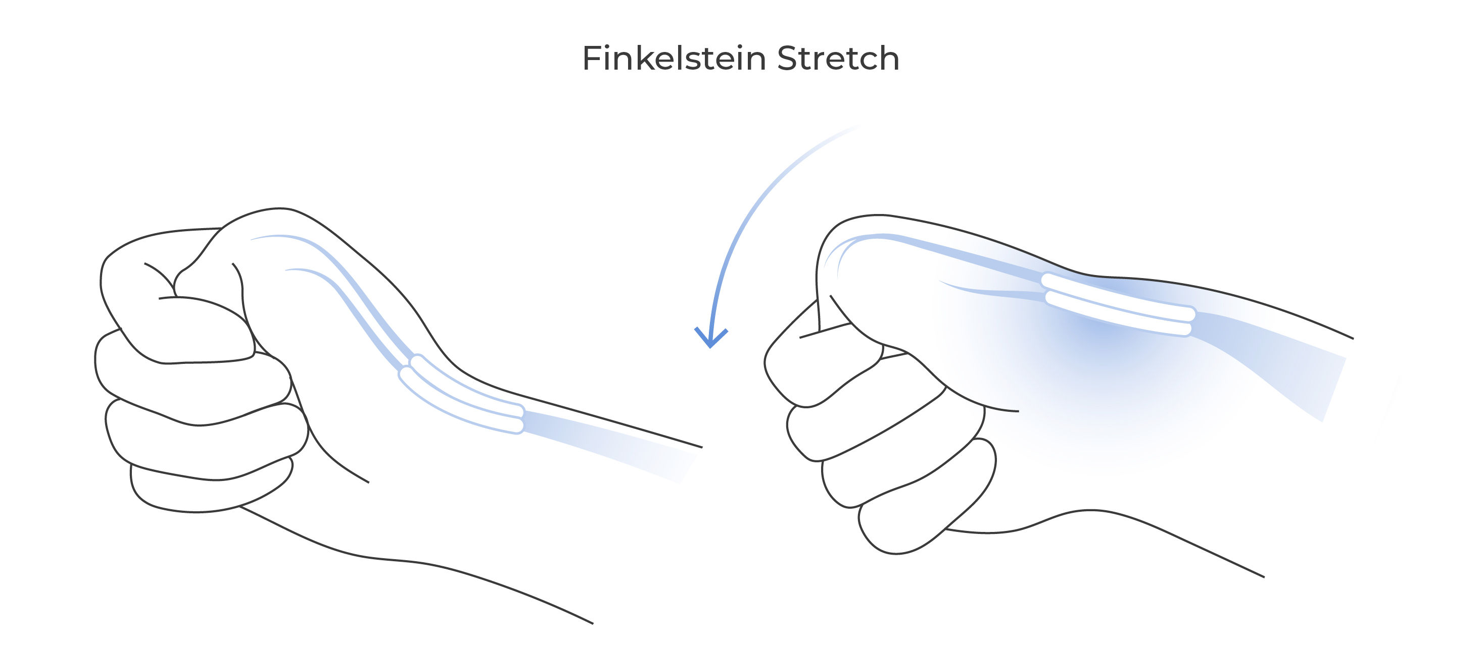 Illustration showing the Finkelstein stretch with the thumb tucked into the palm and the wrist bent toward the little-finger side.