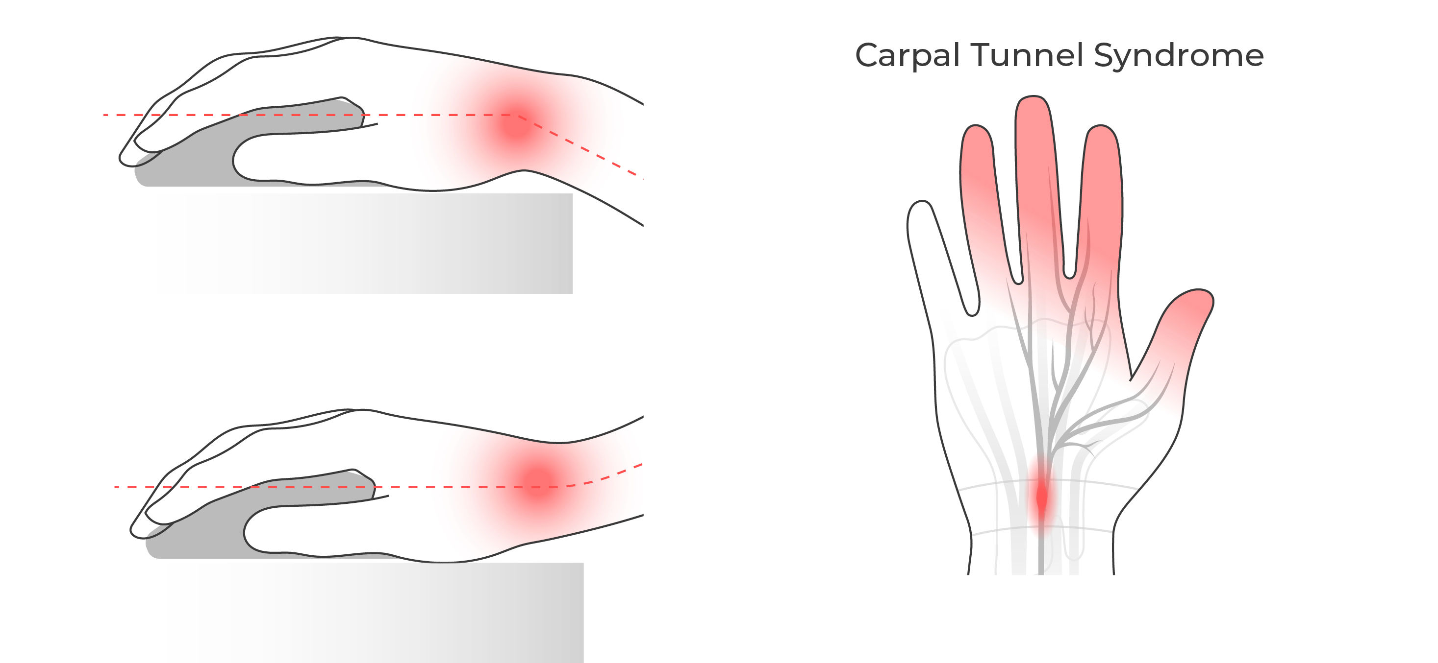 Illustration showing wrist extension and flexion caused by improper mouse height, with the carpal tunnel area highlighted.