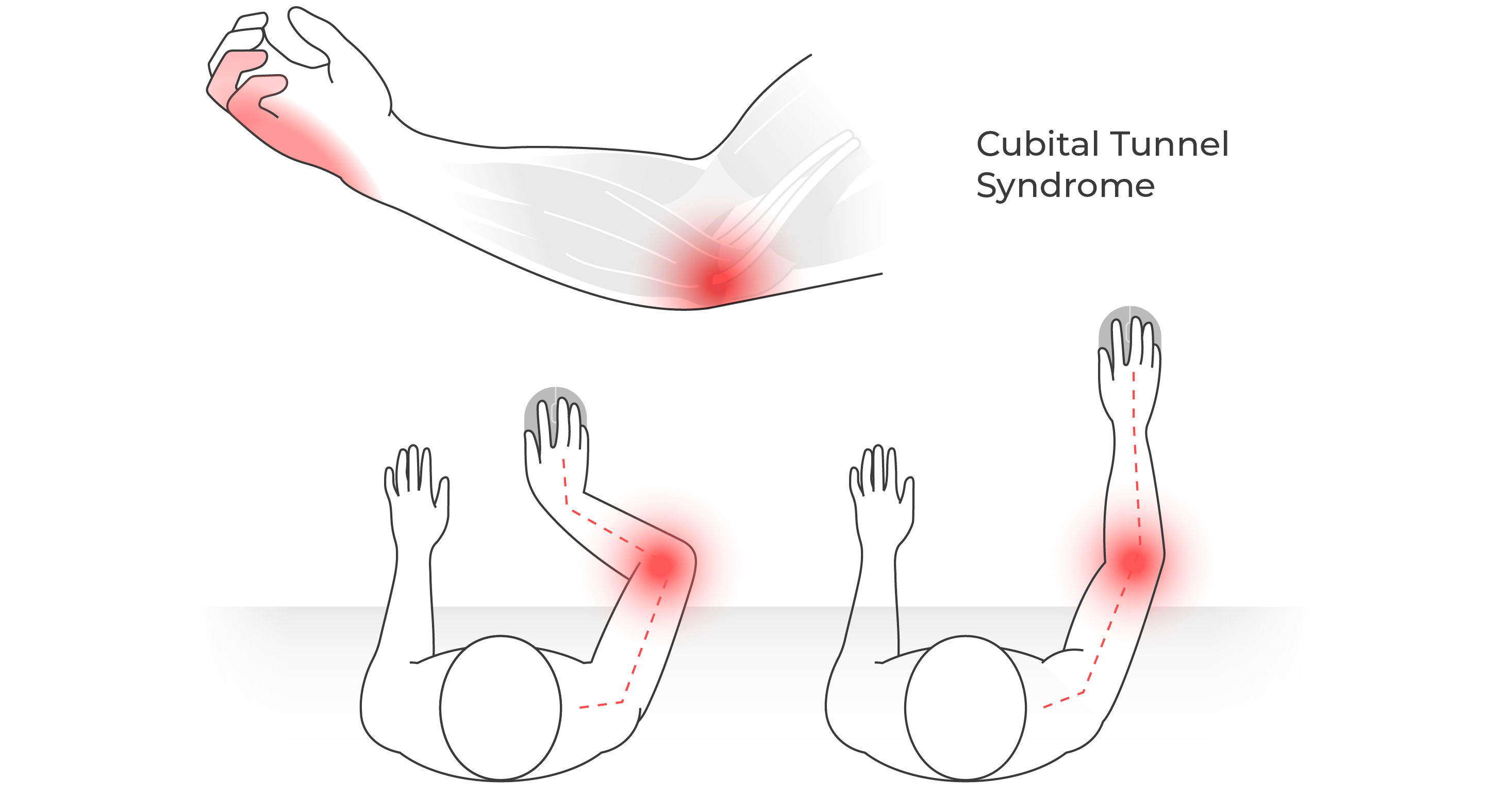 Illustration showing wrist deviation and elbow pressure during mouse use, with the cubital tunnel area highlighted.