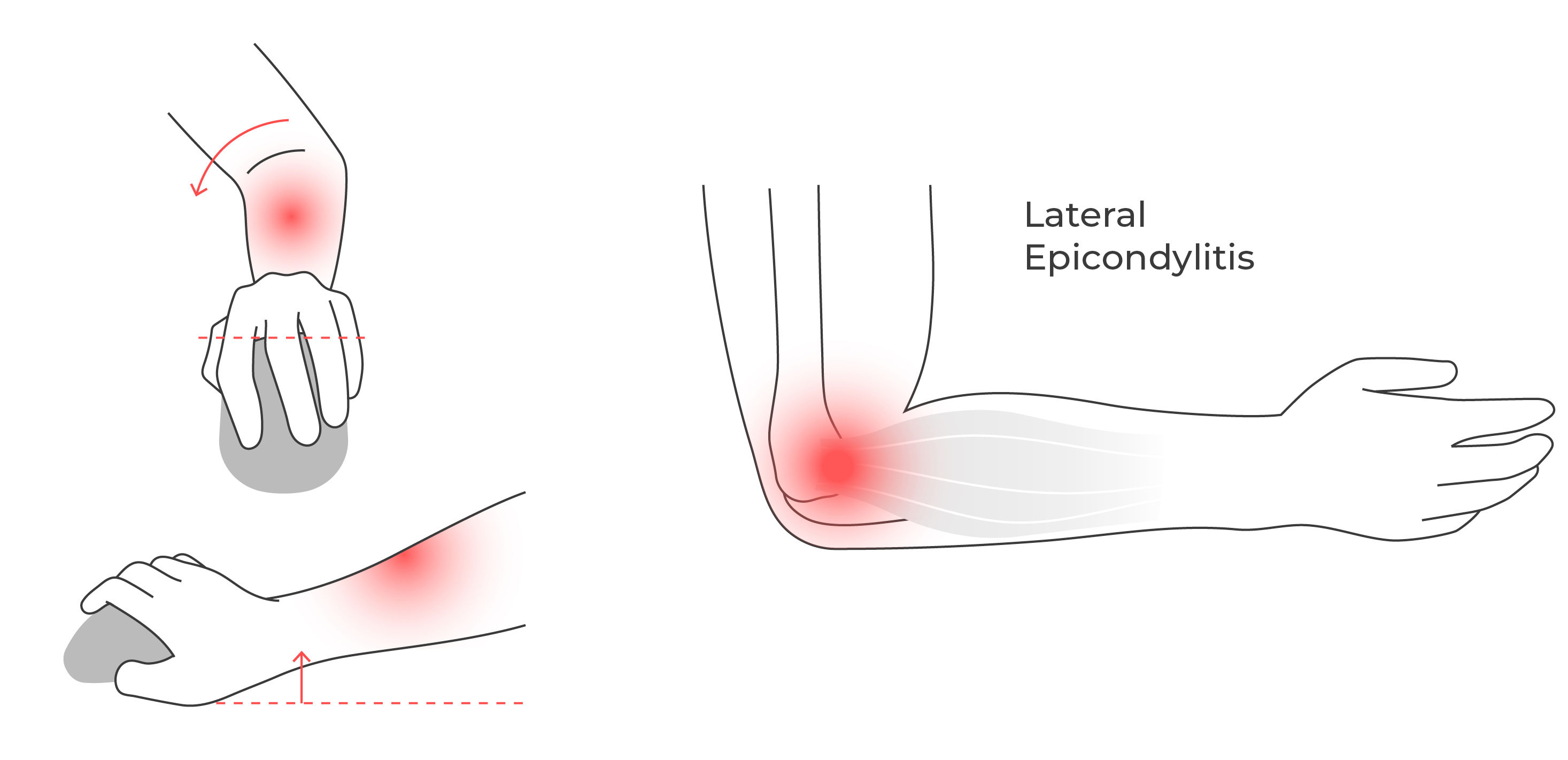Illustration showing forearm pronation during mouse use, with strain highlighted in the wrist, forearm, and outer elbow.
