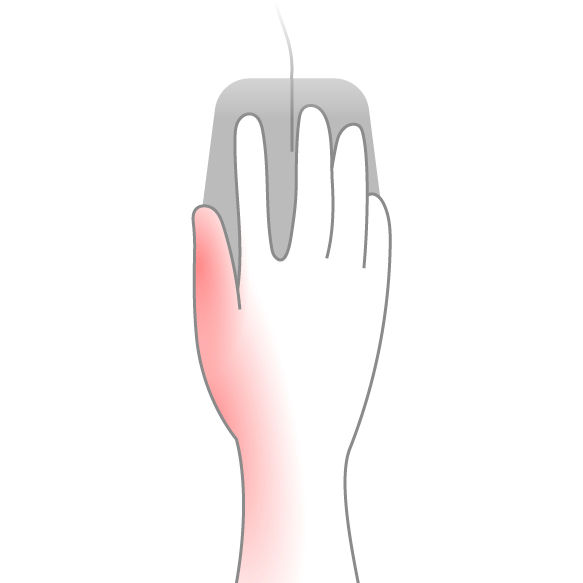 Illustration highlighting the thumb and thumb-side wrist as affected areas from tight mouse gripping.