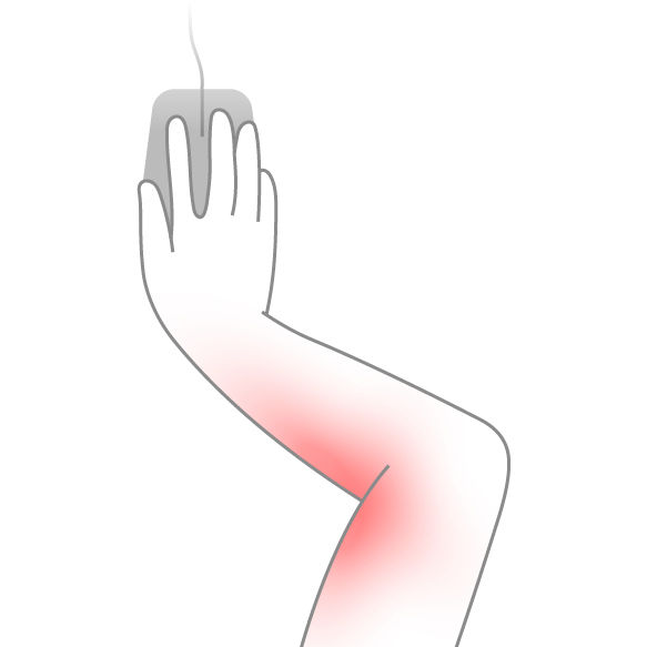Illustration highlighting the inner elbow area affected by prolonged elbow flexion or pressure while using a mouse.