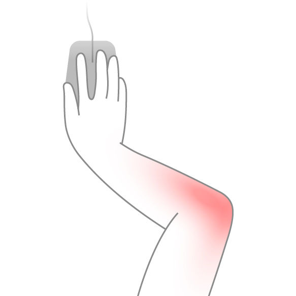 Illustration highlighting the outer elbow area affected by forearm rotation or tight mouse gripping during mouse use.