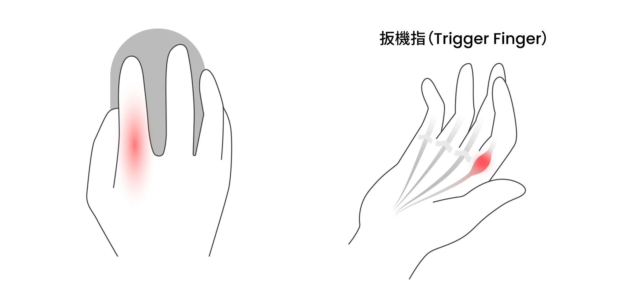 插圖說明了反覆點擊滑鼠及捲動，可能使手指屈肌肌腱負擔過重，導致彈弓指。