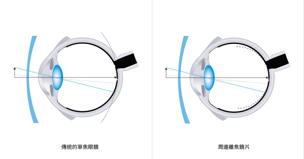 BenQ親子系列_眼科爸爸醫生這樣做